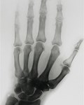 X-ray of Joseph Lister’s hand